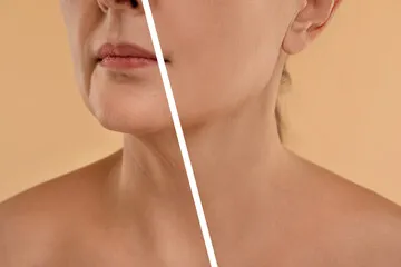 Bioestimulador colágeno procedimento