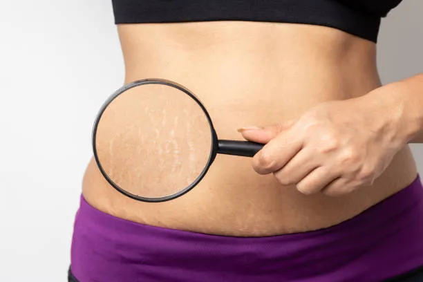 Clínica para tratamento de estrias a laser