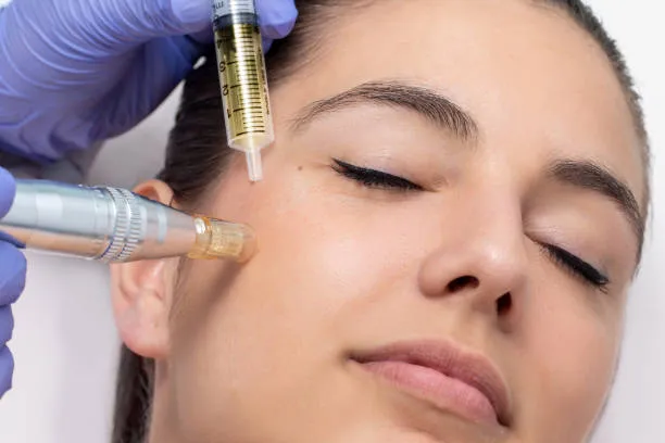 Microagulhamento facial em São Paulo
