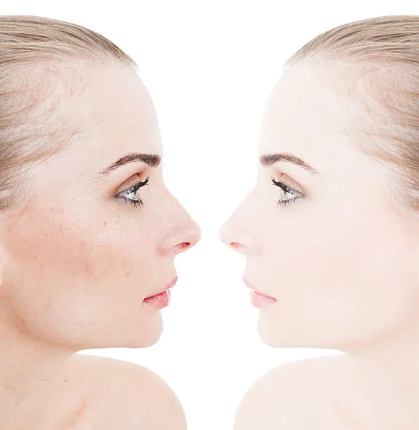 Microfocado full face