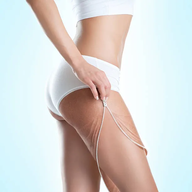 Tratamento para estrias branca a laser