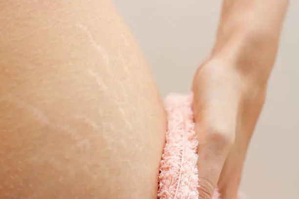 Tratamento de estrias laser co2
