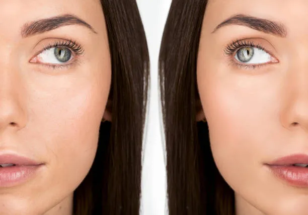 Ultrassom microfocado olhos