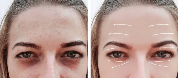 Ultrassom microfocado palpebras