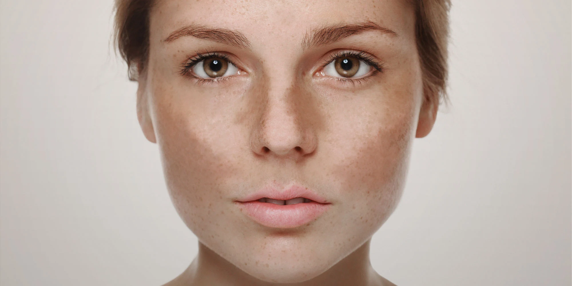 Melasma e outras alterações pigmentares Ak Dermatologia
